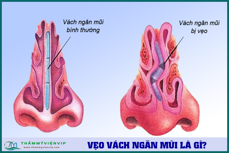 Vẹo vách ngăn ở mũi là gì?